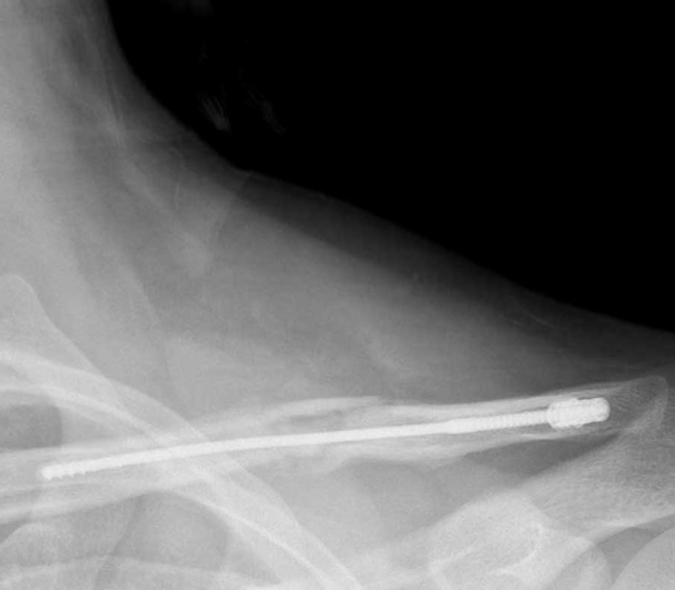 X ray of clavicle with anser pin